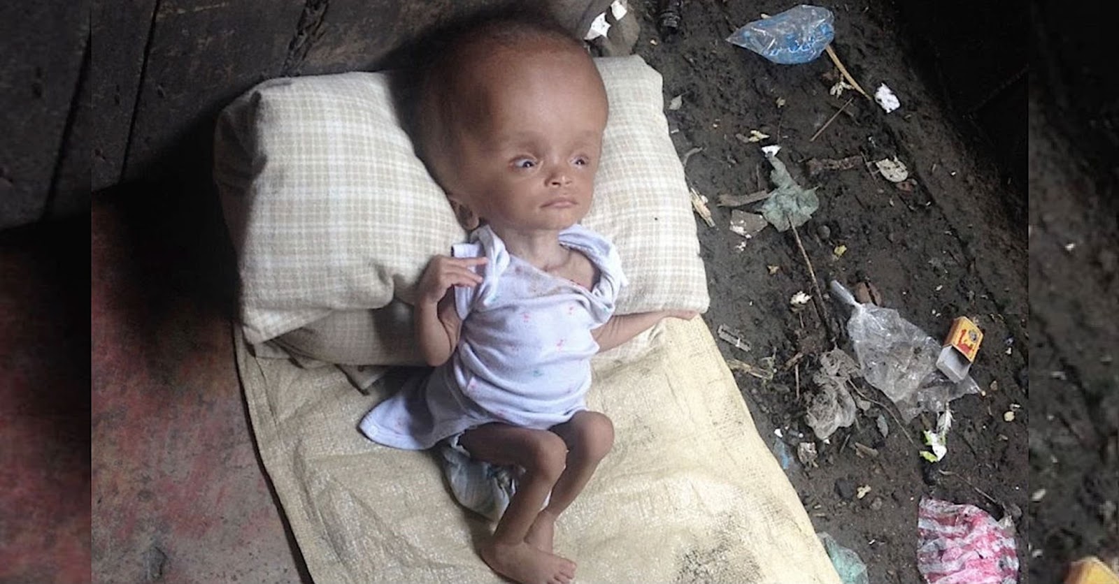 Vogëlushja cilësohej si mallkim për prindërit prej sëmundjes, jeta e saj ndryshon pas adoptimit